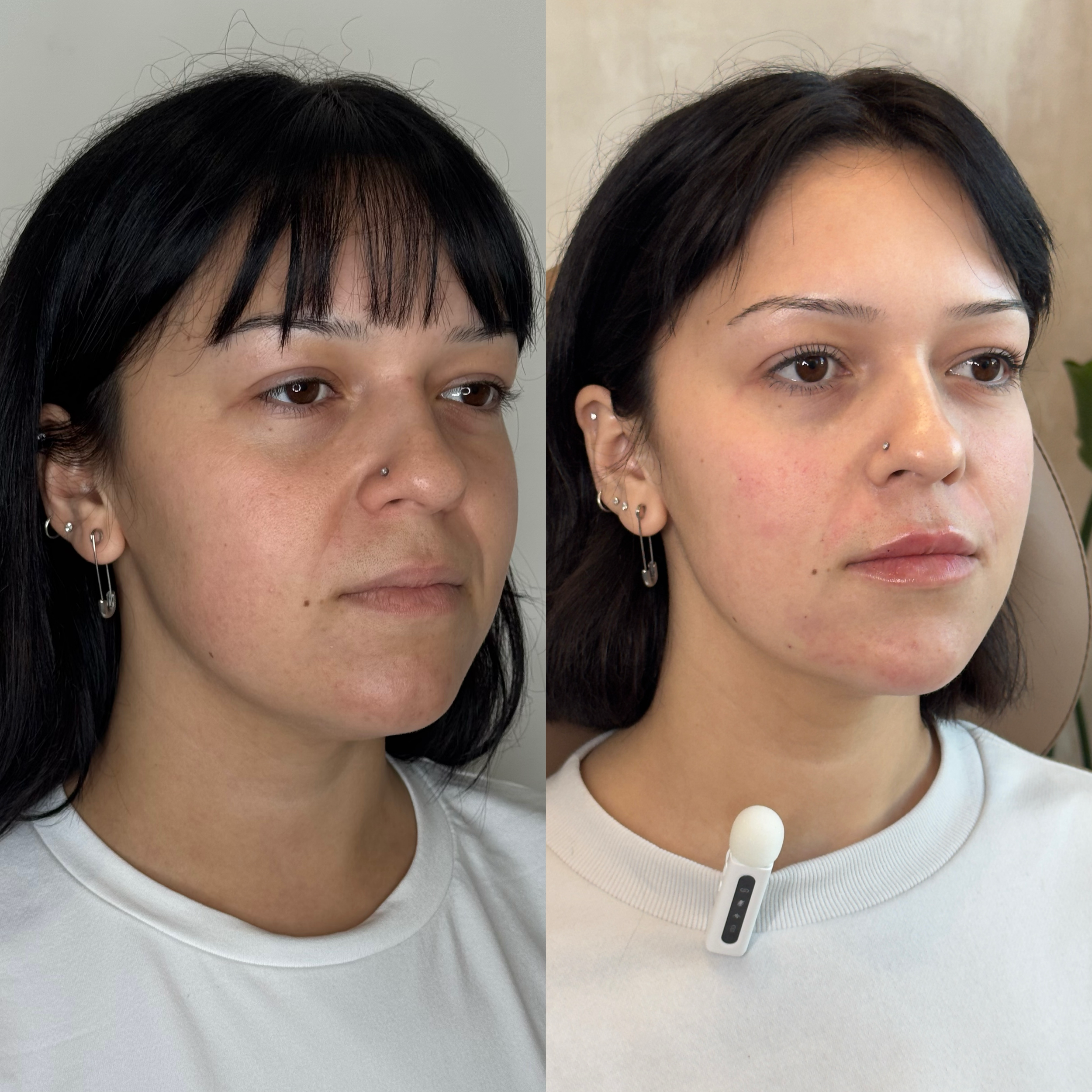 Side-by-side comparison of a woman before and after a skincare treatment, showing improved skin clarity and texture.
