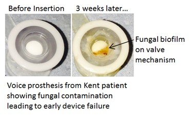 Voice Prosthesis showing fungal contimination