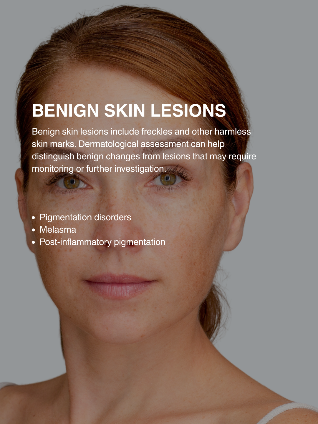 freckles, benign skin lesions, including freckles