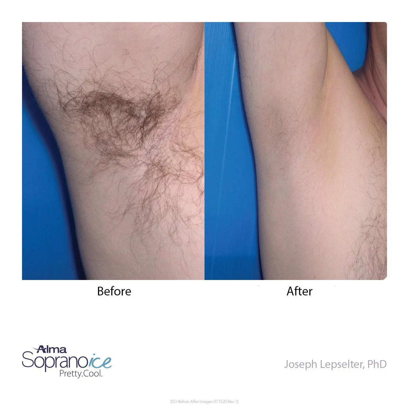 Comparison of a person's underarm before and after hair removal treatment, showing dense hair in the before image and smooth skin in the after image.