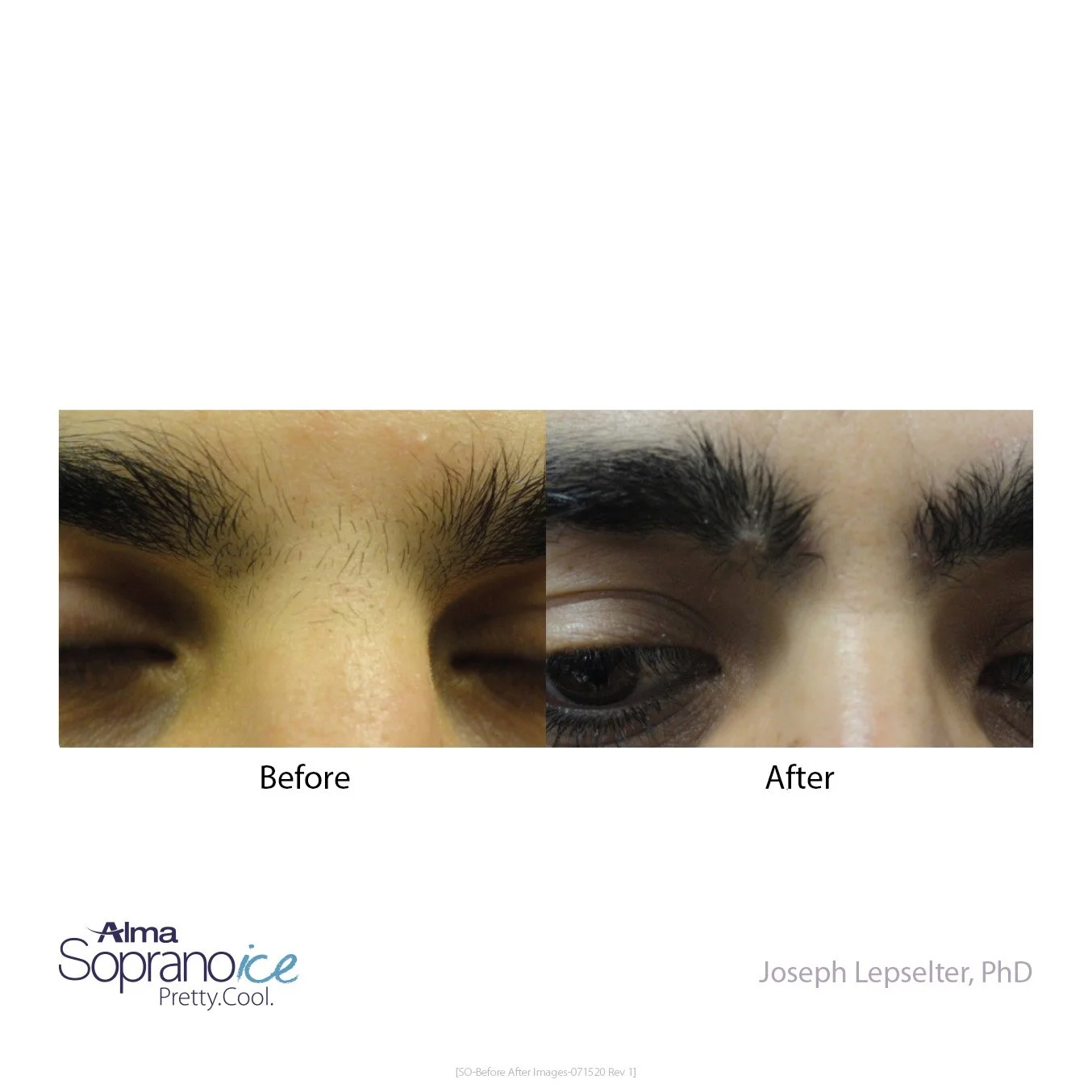 Comparison of eyebrows before and after treatment, showing thinning and sparse eyebrows in the 'Before' image and fuller, darker eyebrows in the 'After' image. Contains the logos 'Alma Soprano ice Pretty.Cool.' and credits to Joseph Lepslater, PhD.