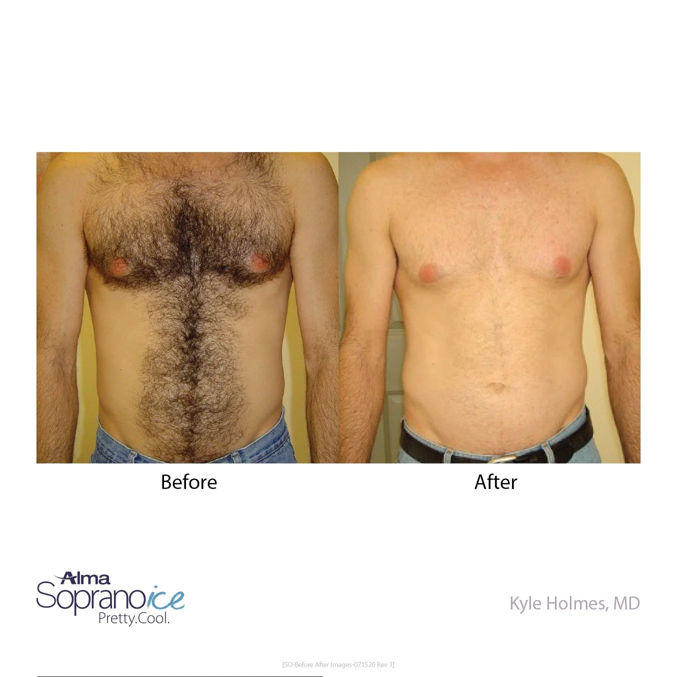 Side-by-side comparison of a man's chest before and after hair removal treatment. The 'before' shows a hairy chest, while the 'after' shows a bare chest with some redness around the nipples.