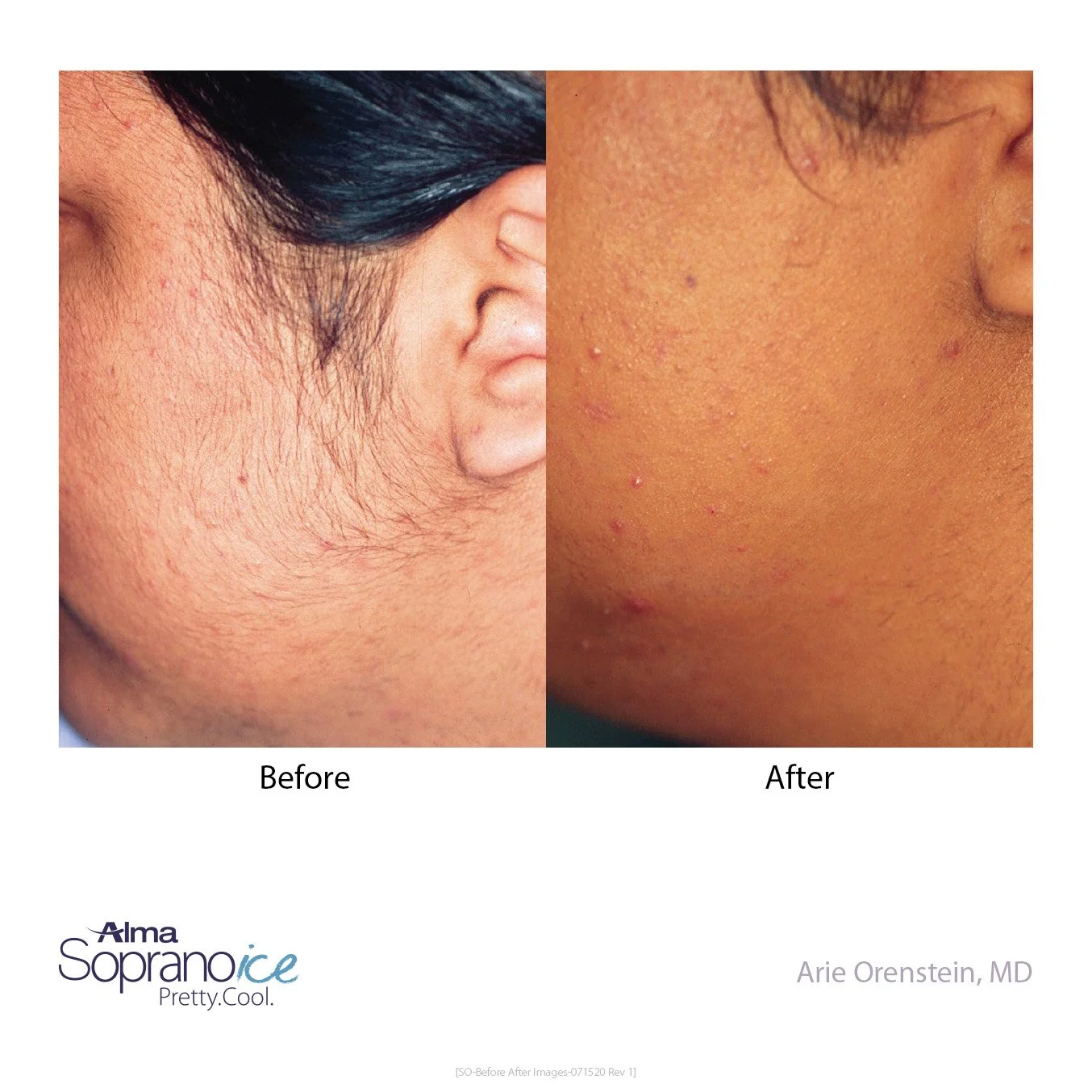 Comparison of facial skin before and after hair removal treatment. Left side shows skin with hair and some redness, right side shows smooth skin with few small blemishes.