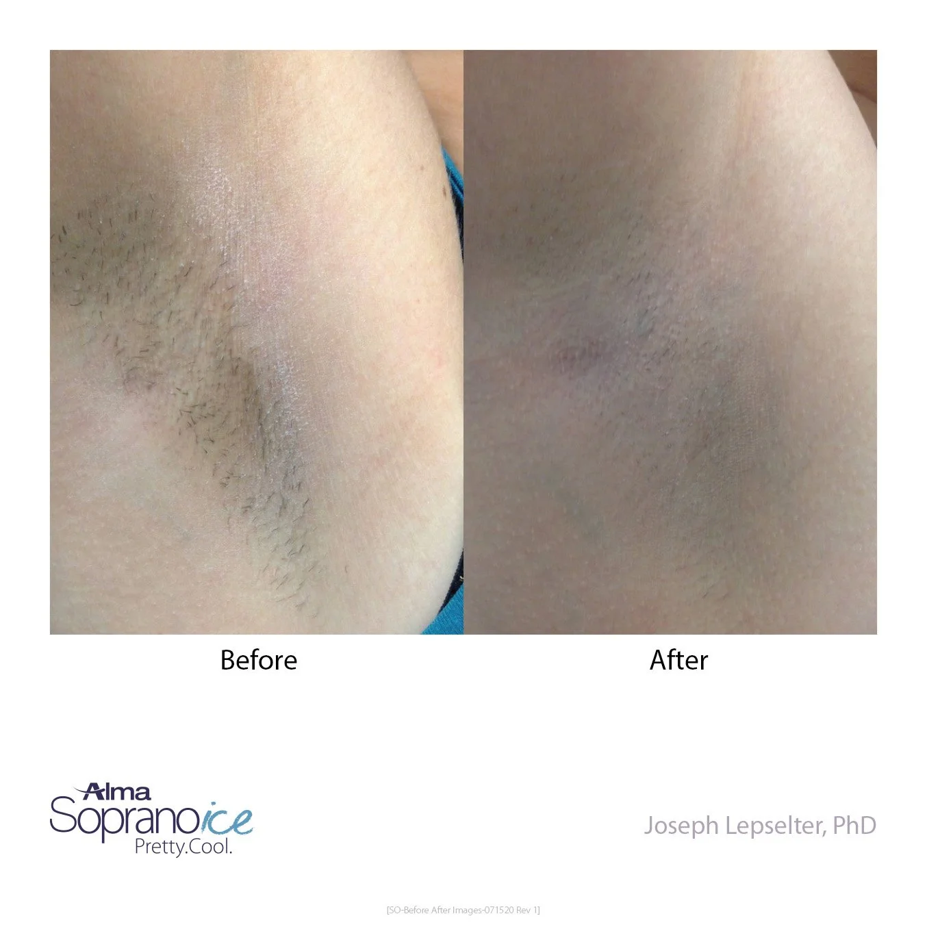 Side-by-side comparison of armpit hair removal, with a 'Before' image showing hairy armpit and an 'After' image showing smooth, hairless armpit.