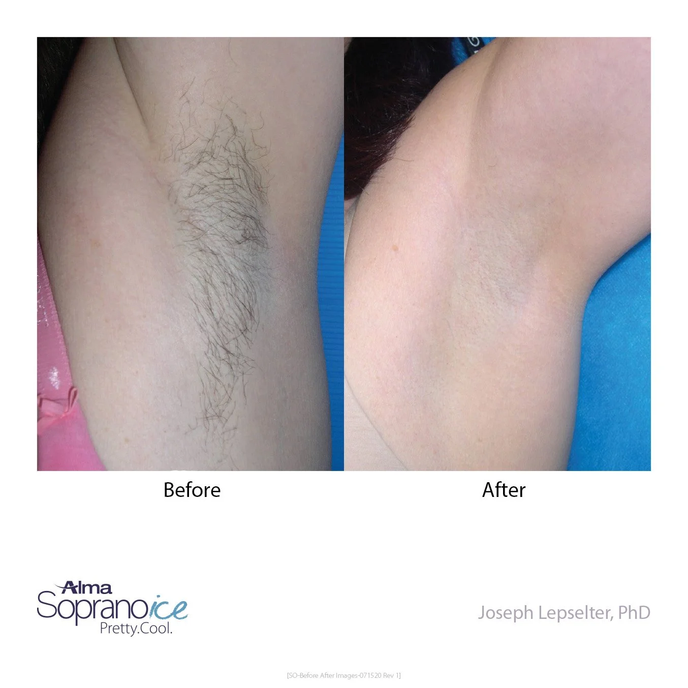 Comparison of a person's underarm before and after hair removal treatment. The left side shows an armpit with visible hair, while the right side shows a smooth, hairless armpit.
