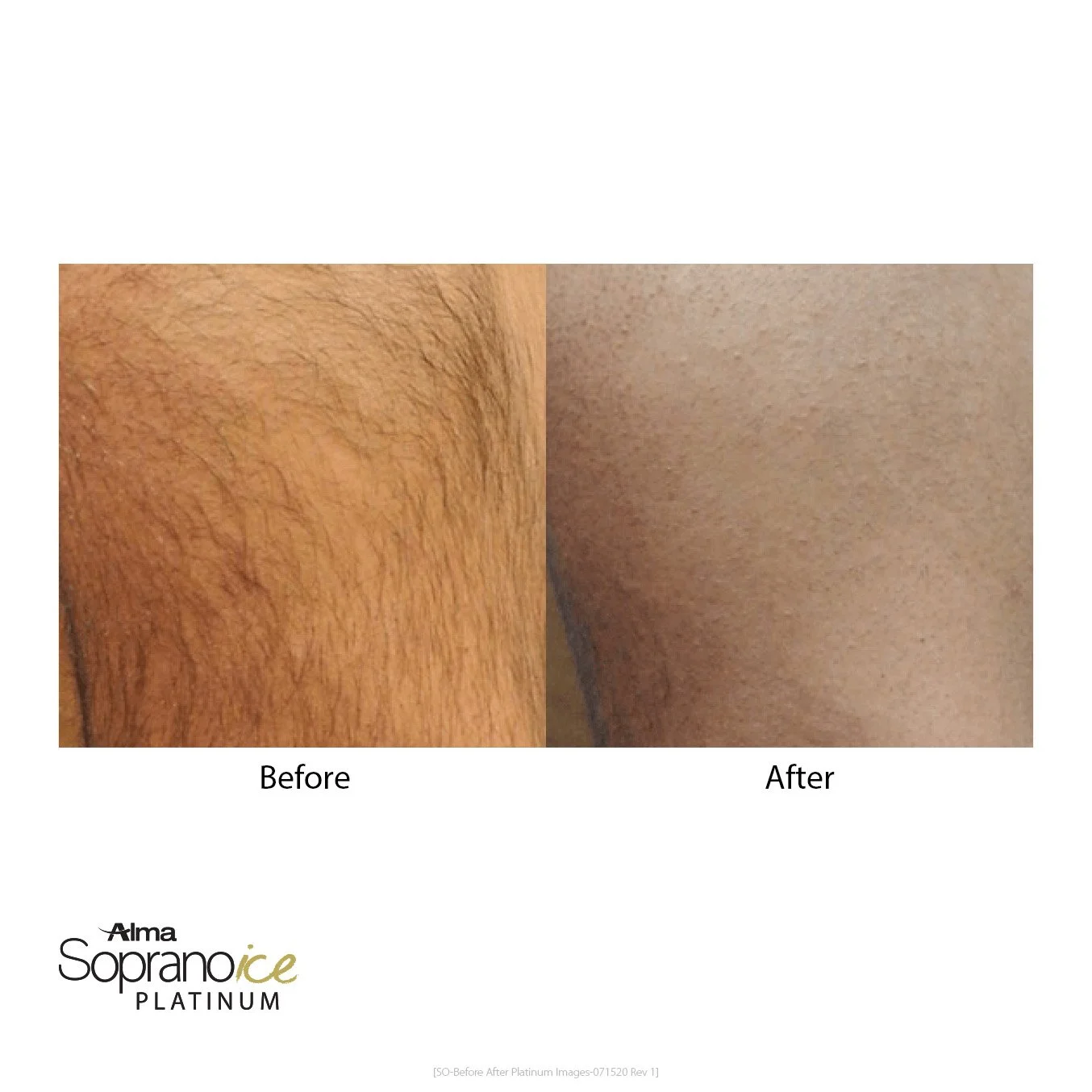 Comparison of skin before and after using a hair removal product, showing reduced hair and smoother skin after treatment.