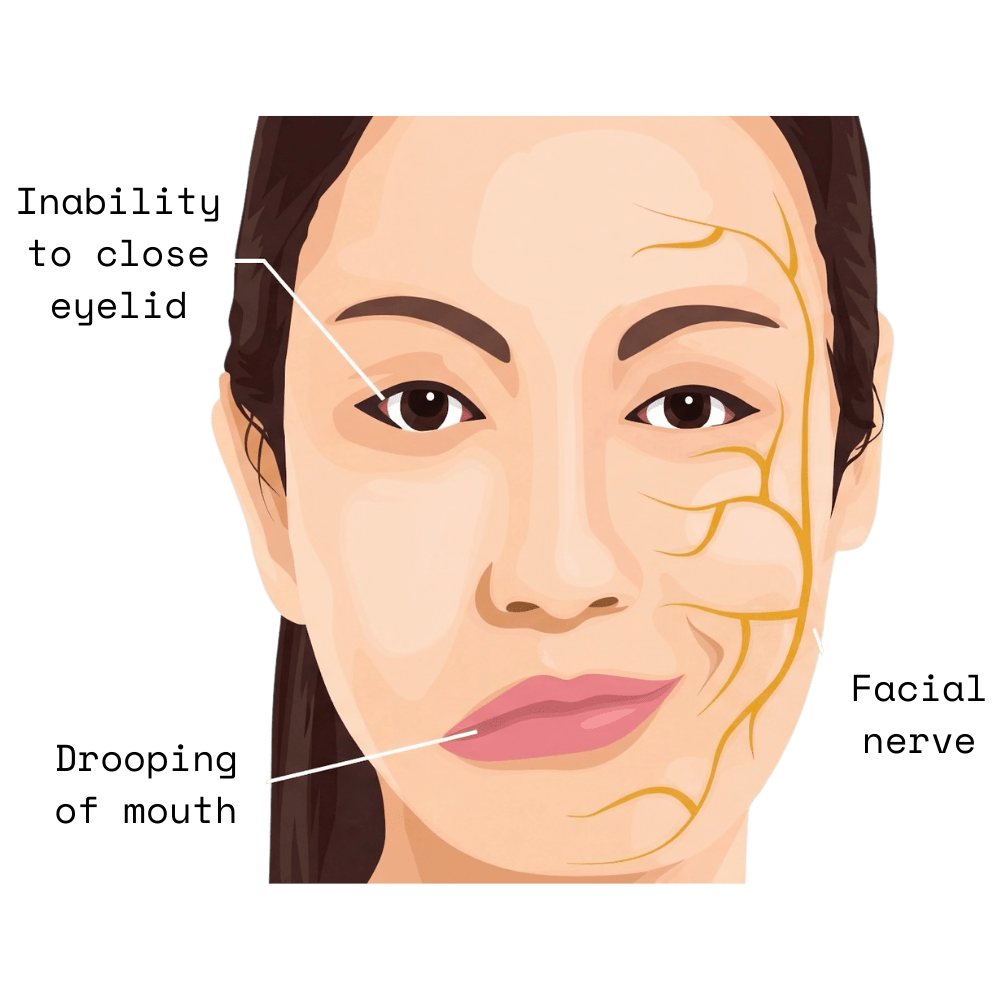 Bell's Palsy in Fiji: What It Is, What It Isn't, and How Physiotherapy Helps