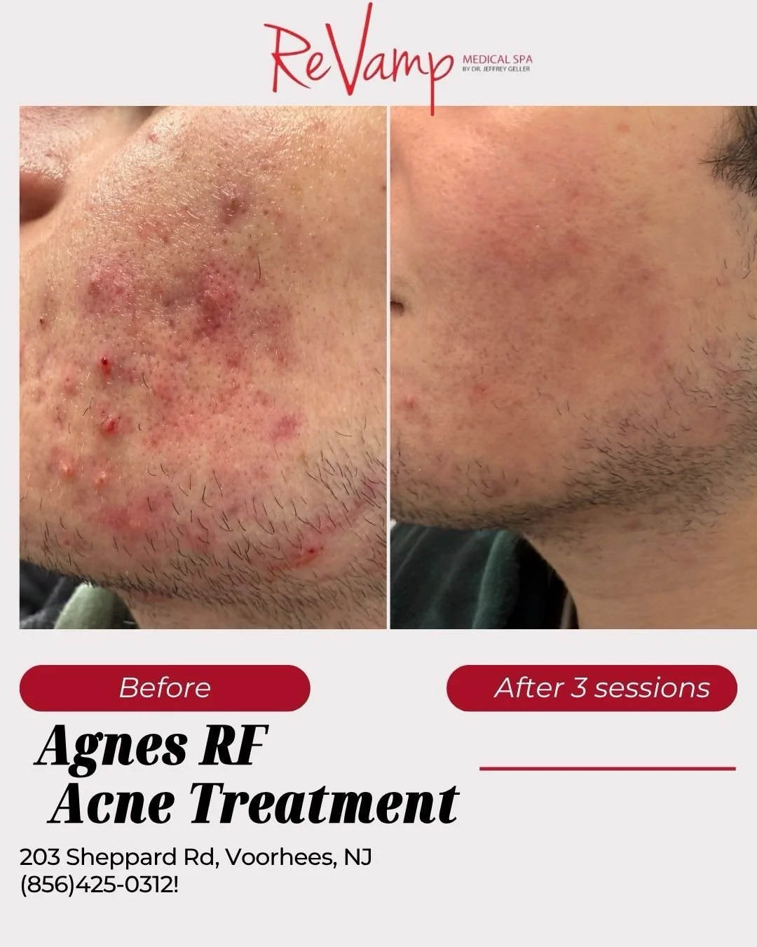 Before and after images of a man's face showing improvement in acne, with text indicating a treatment at Agnes RF Acne Treatment after 3 sessions.