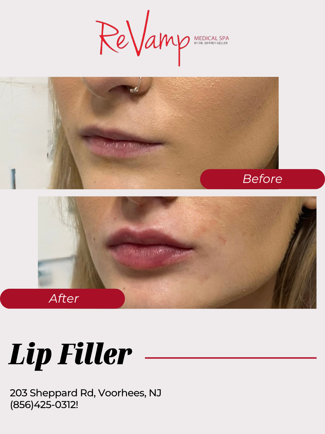 Before and after photos of a woman's lips showing the results of lip filler treatment at ReVamp Medical Spa in Voorhees, New Jersey.
