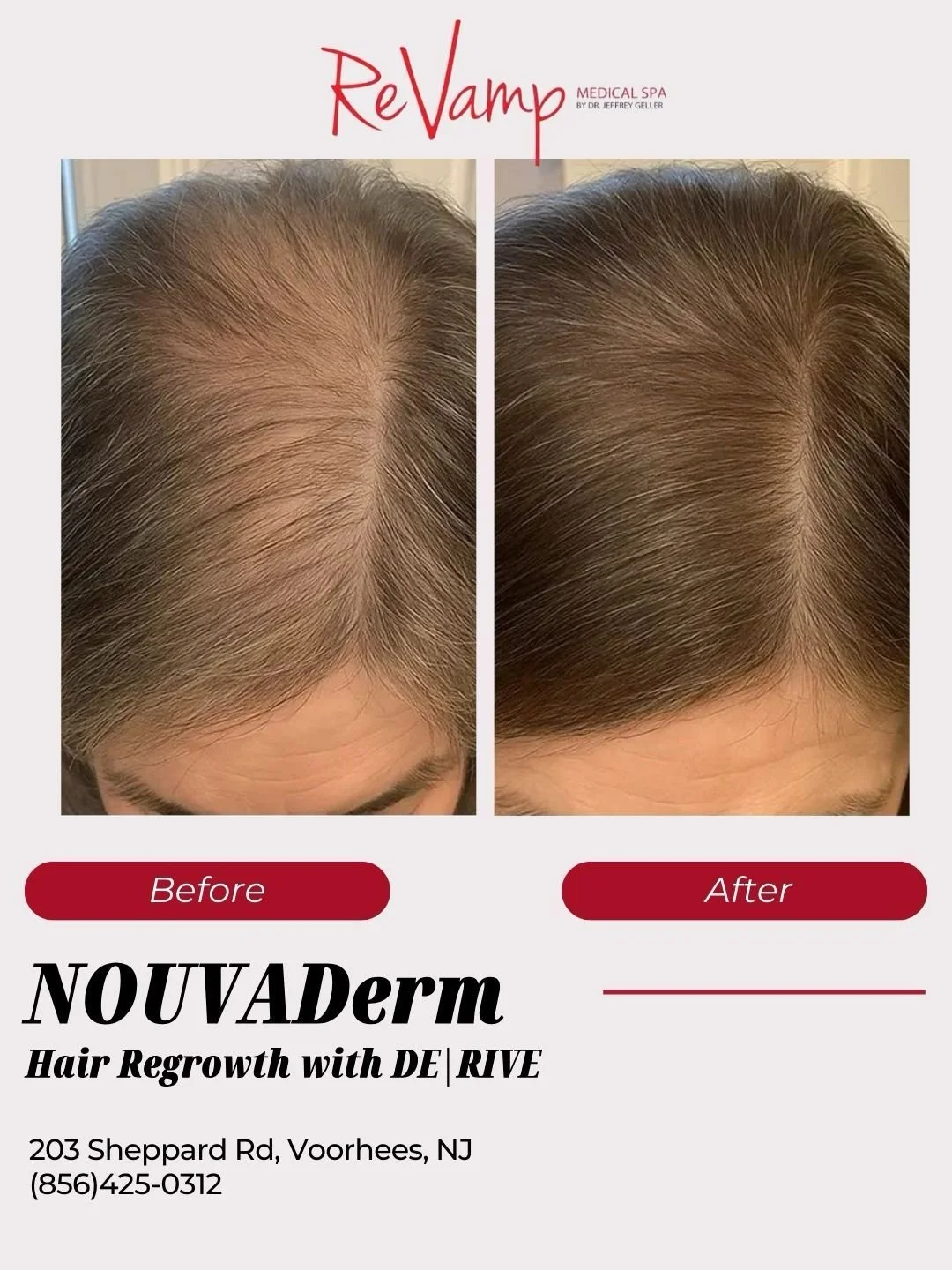 Advertisement comparing before and after photos of hair regrowth treatment showing increased hair density on top of a person's head, with the text "ReVamp Medical Spa" and a description of the hair regrow method "NOUVΑDerm Hair Regrowth with DE|RIVE".
