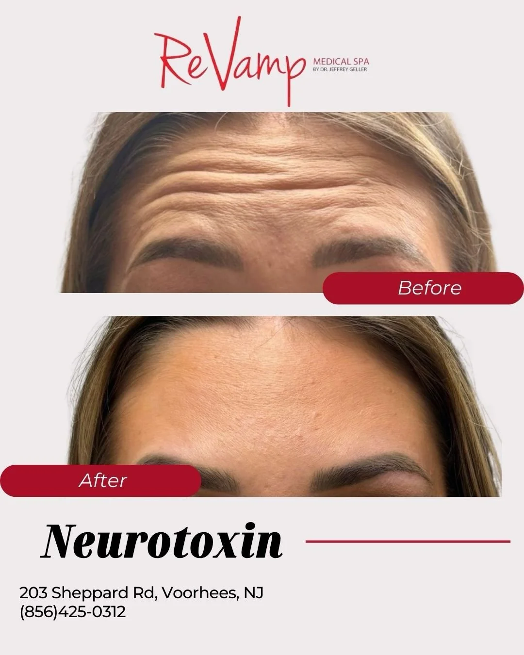 Before and after images showing forehead wrinkles reduction from Neurotoxin treatment at ReVamp Medical Spa, Voorhees, NJ.
