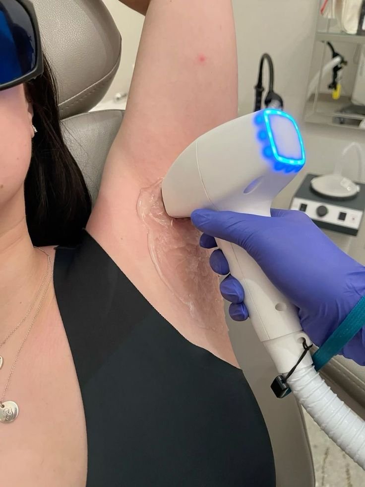 A person receiving laser hair removal treatment on their underarm area in a clinical setting. The technician is holding a laser device with blue LED lights, and the person is wearing protective glasses.