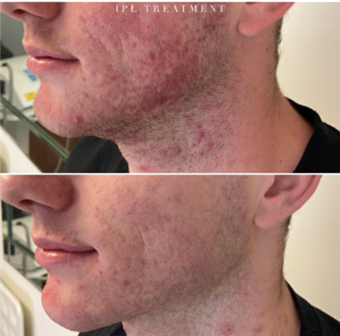 Microdemabrassion Facial