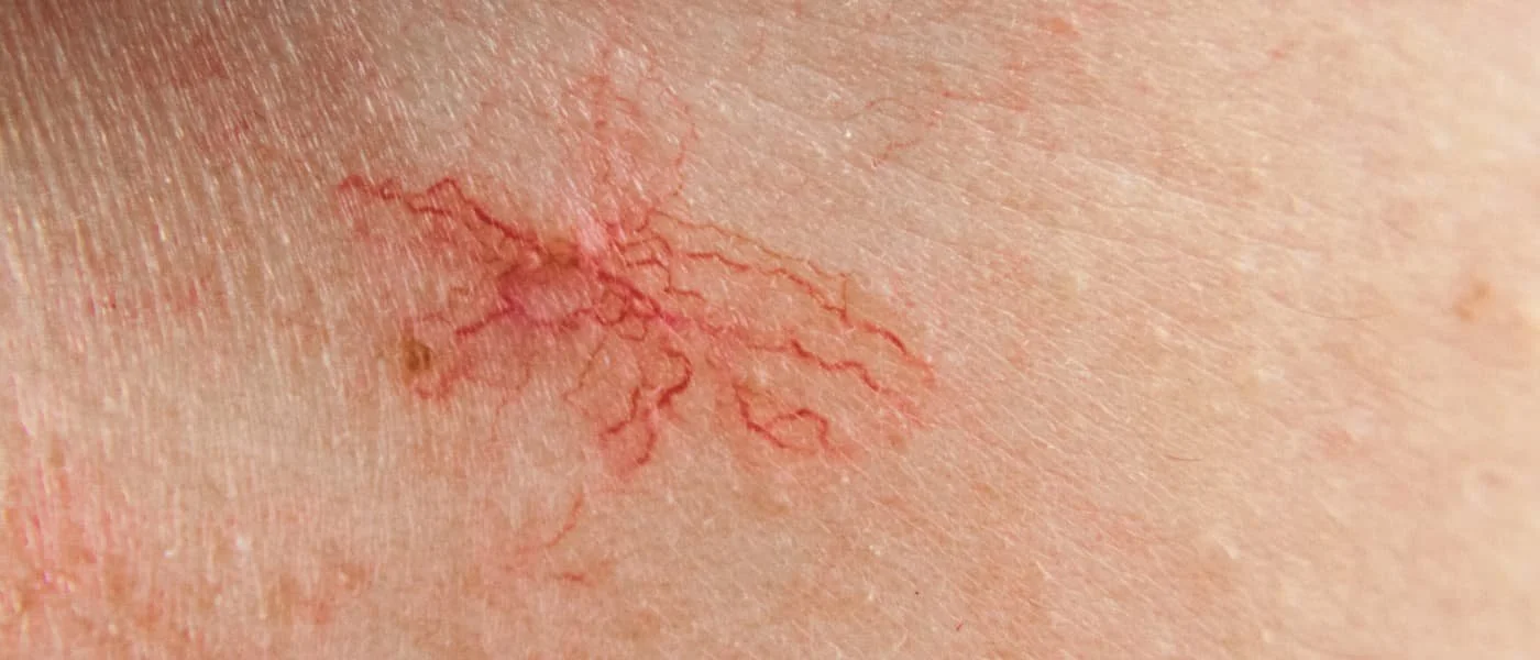 IPL Vascular Laser  Treatment Package x3