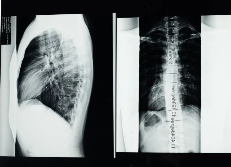 What To Expect With Scoliosis?