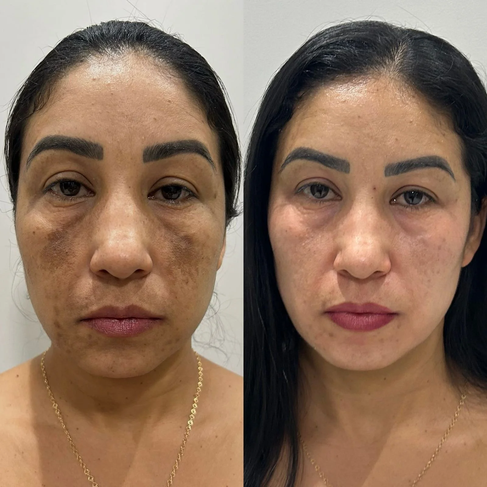 Side-by-side comparison of a woman's face before and after skincare treatment, showing improved skin texture and reduced pigmentation.