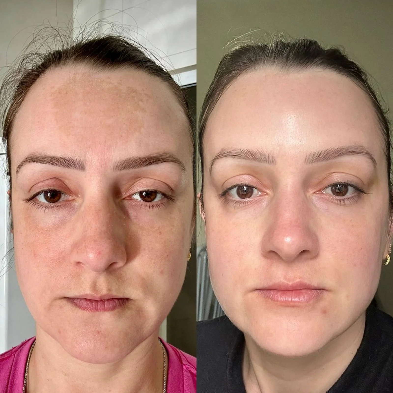 Comparison photo showing a woman's face before and after skincare treatment. The left side shows her with visible dark spots, uneven skin tone, and puffiness, while the right side shows clear, even-toned, and refreshed skin.