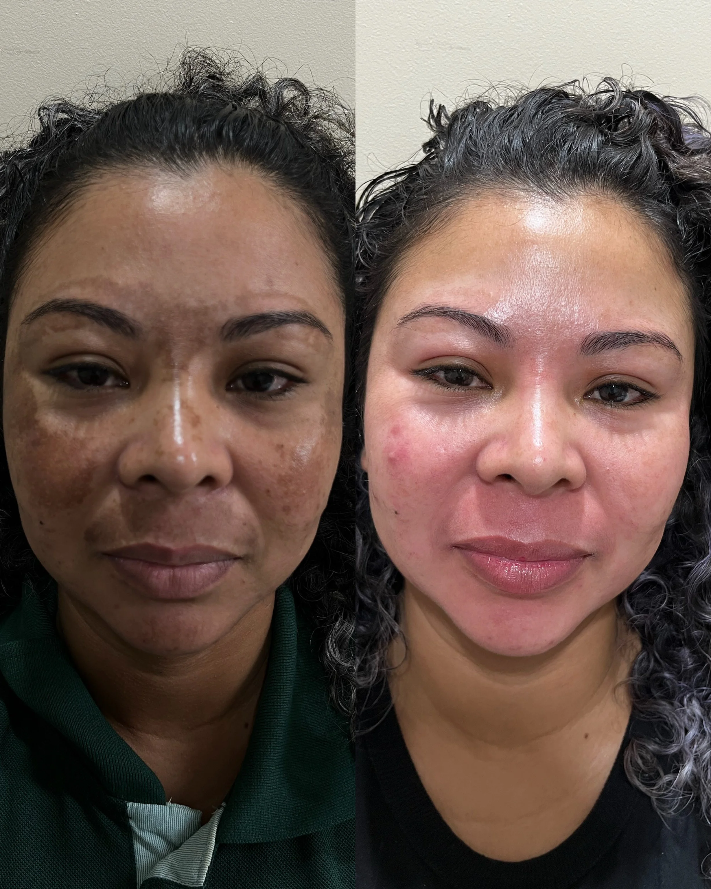 Side-by-side comparison of a woman before and after skincare treatment, showing improved skin clarity and reduced hyperpigmentation.
