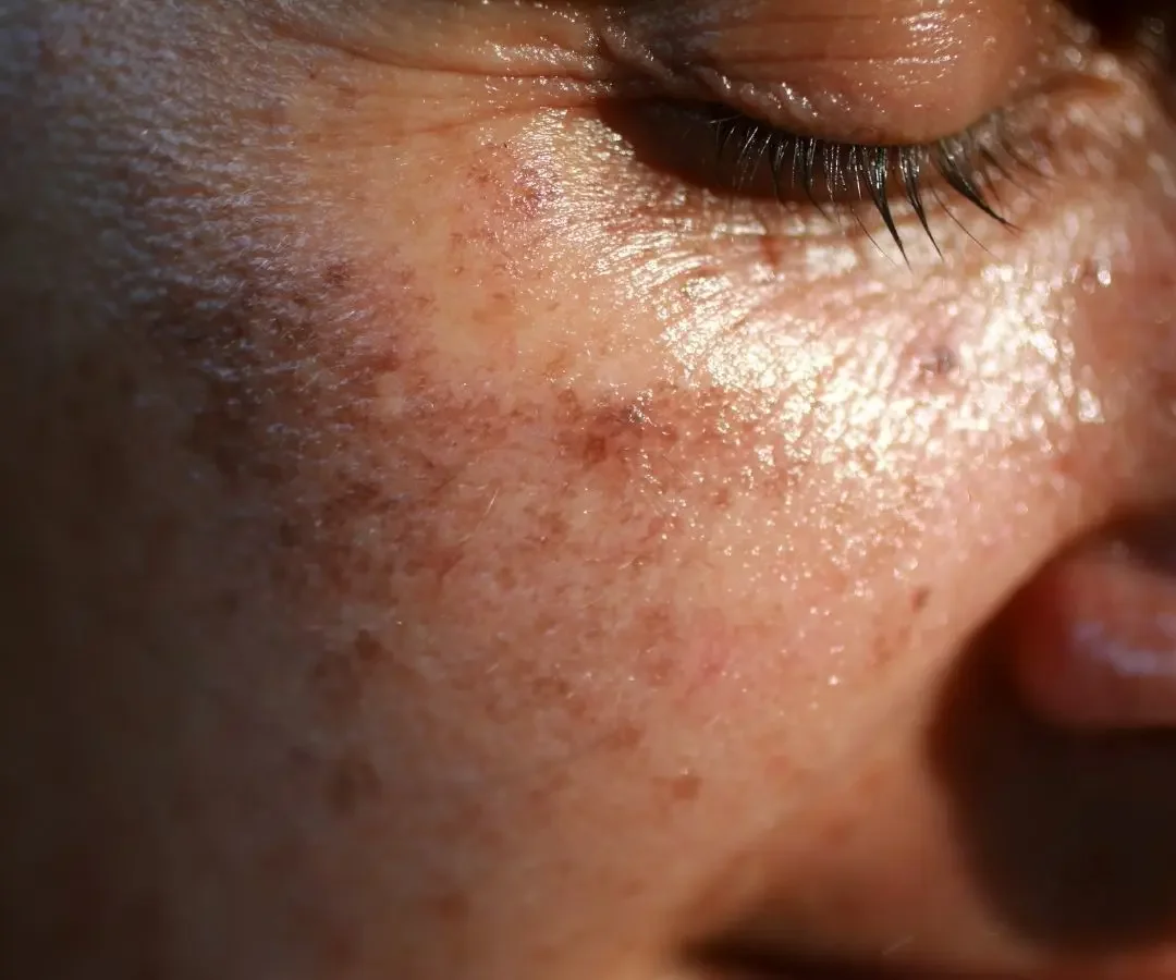 Why Does Sun Damage Become More Noticeable as We Age?