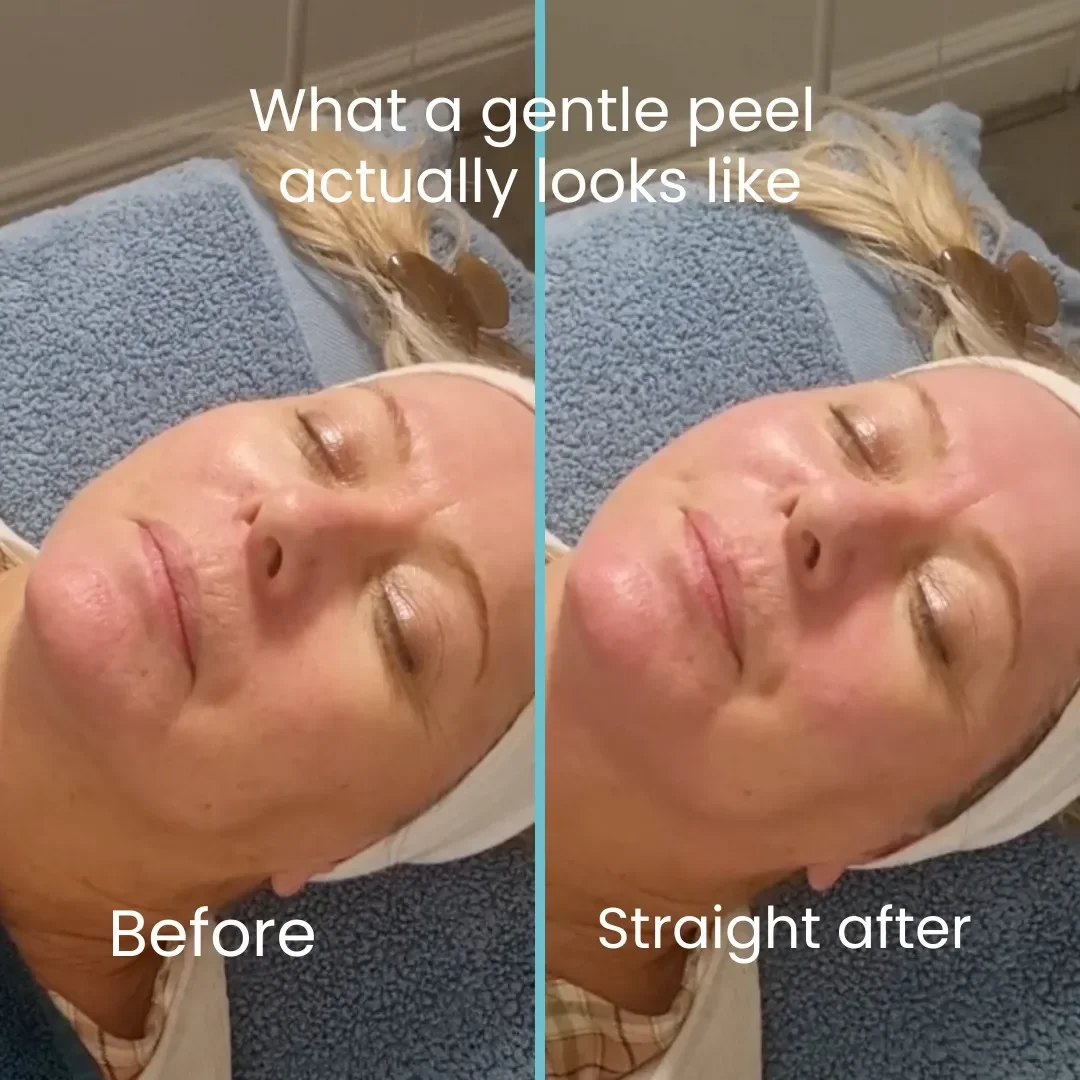 Comparison photo showing a woman's face before and after a facial treatment, with the text "What a gentle peel actually looks like" and labels "Before" and "Straight after."