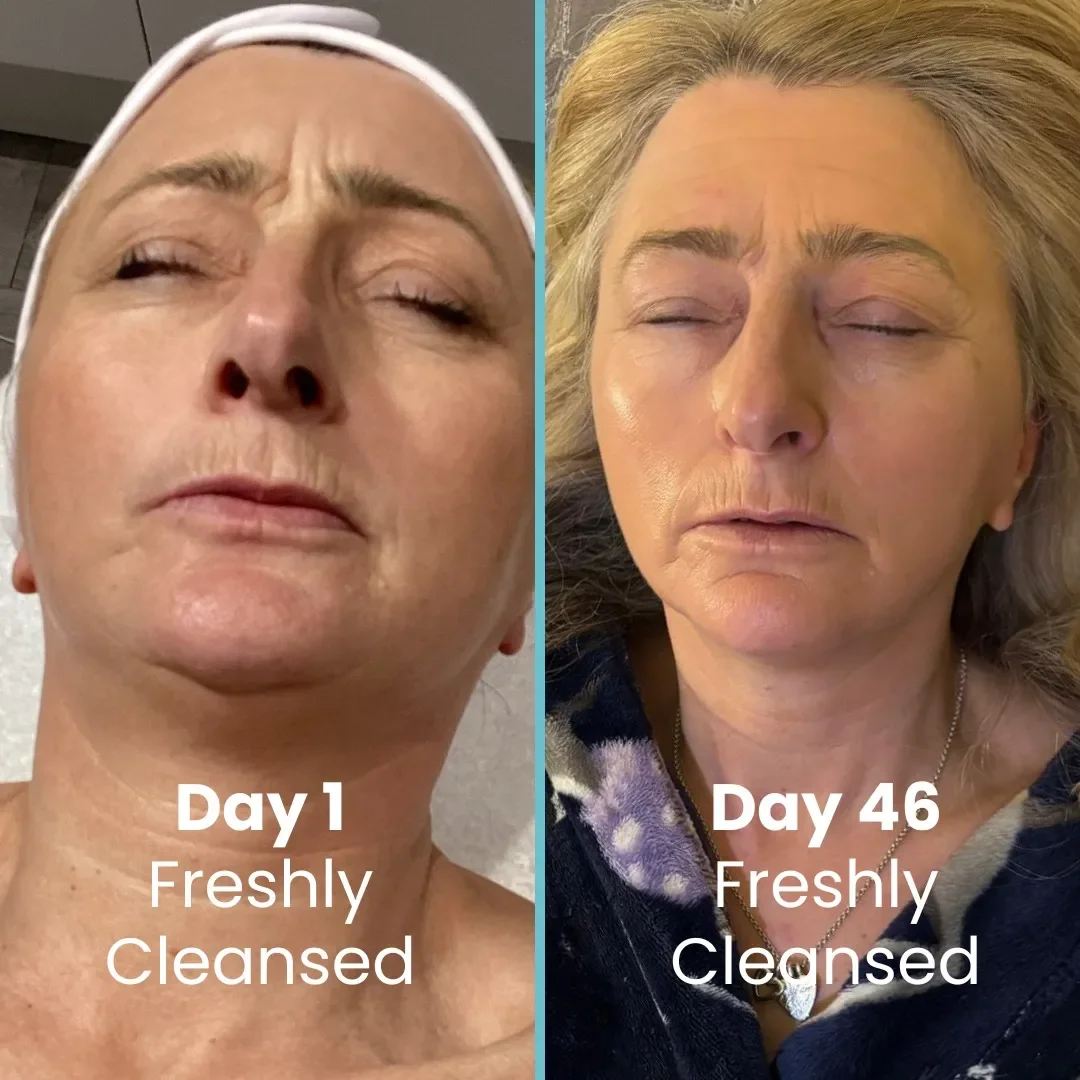 Comparison of a woman’s face on day 1 and day 46. Both images show her with eyes closed and a neutral expression. The day 1 image notes she was freshly cleansed, and so is the day 46 image.