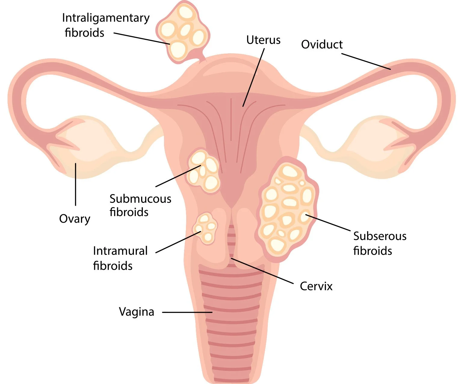 Dr Caroline Mathias Specialist Gynaecological Surgeon Sydney Uterine Fibroid Surgery