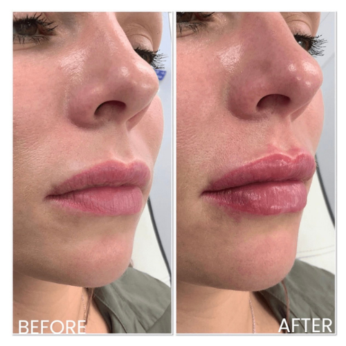 BreNova Wellness  Medspa in Elm Grove, WI, 53122  Botox, Fillers, GLP-1