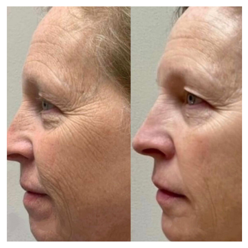 BreNova Wellness  Medspa in Elm Grove, WI, 53122  Botox, Fillers, GLP-1