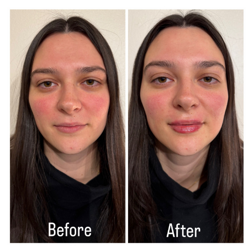 BreNova Wellness  Medspa in Elm Grove, WI, 53122  Botox, Fillers, GLP-1