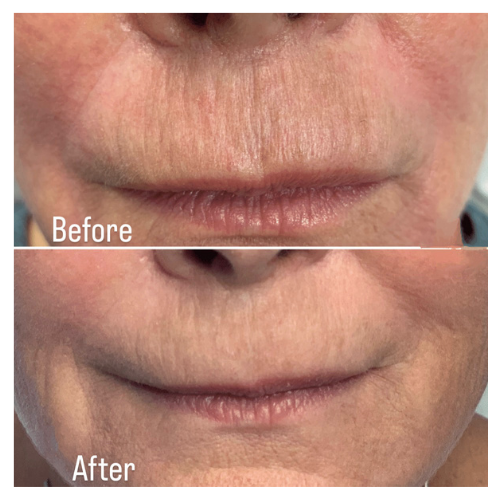 BreNova Wellness  Medspa in Elm Grove, WI, 53122  Botox, Fillers, GLP-1