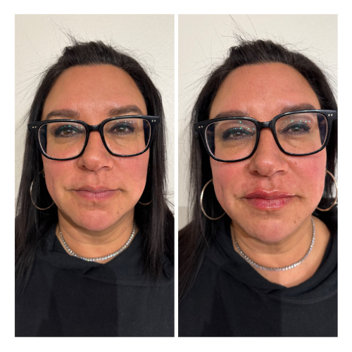 BreNova Wellness  Medspa in Elm Grove, WI, 53122  Botox, Fillers, GLP-1