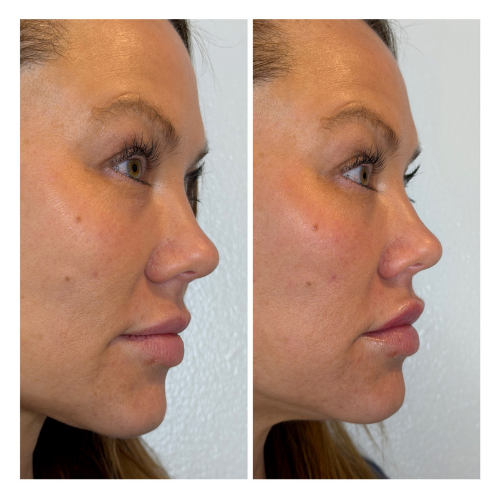 BreNova Wellness  Medspa in Elm Grove, WI, 53122  Botox, Fillers, GLP-1