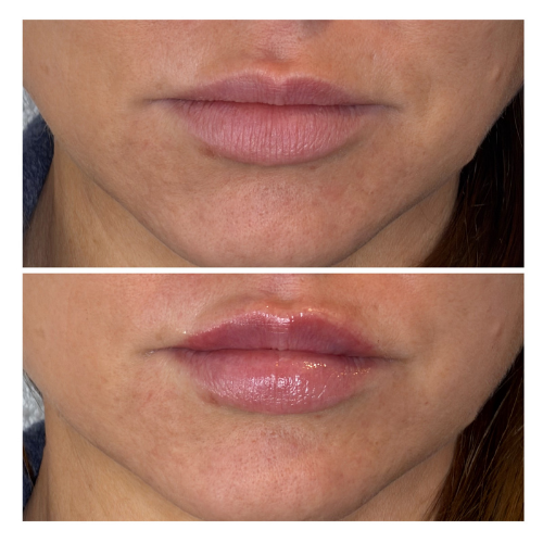 BreNova Wellness  Medspa in Elm Grove, WI, 53122  Botox, Fillers, GLP-1