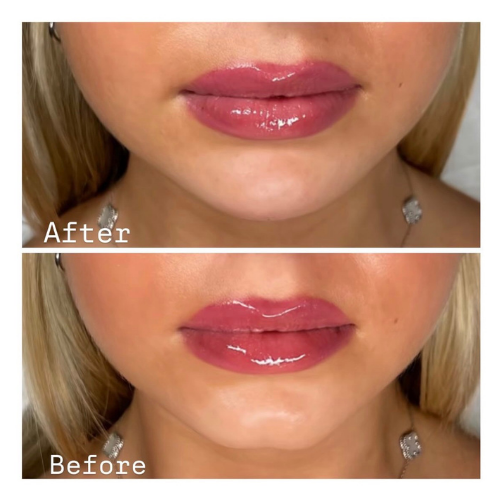 BreNova Wellness  Medspa in Elm Grove, WI, 53122  Botox, Fillers, GLP-1