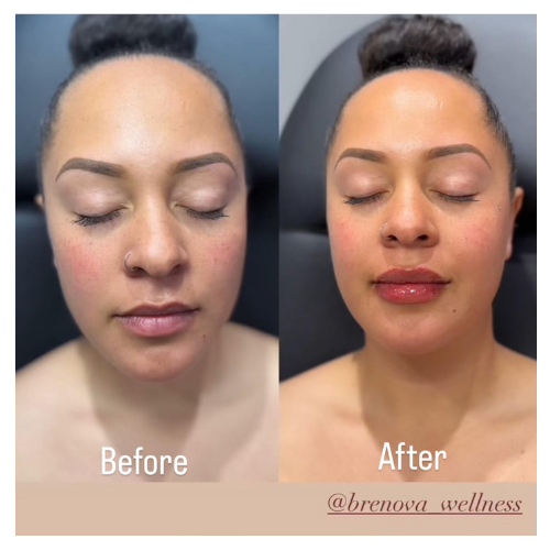 BreNova Wellness  Medspa in Elm Grove, WI, 53122  Botox, Fillers, GLP-1