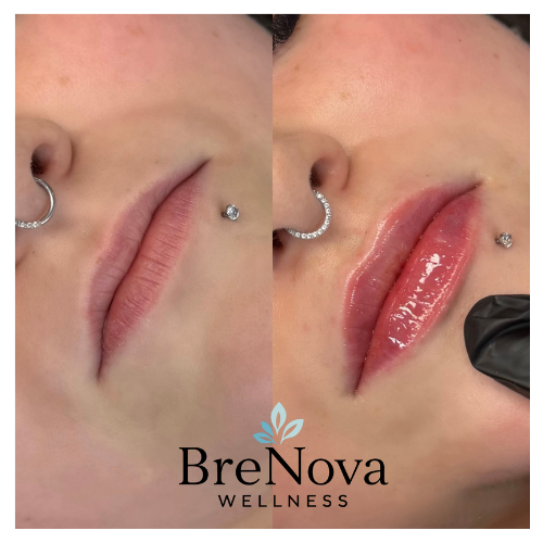Close-up of lips before and after lip gloss application, with a logo for BreNova Wellness at the bottom. Brenova Wellness | Elm Grove, WI Medspa