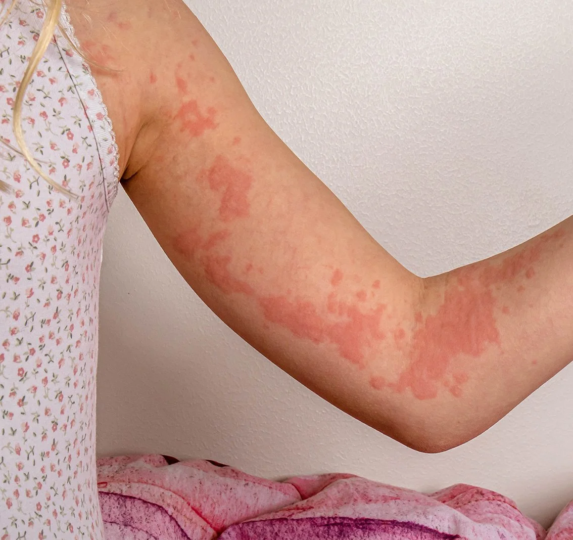 Hives Urticaria Treatment Brisbane Paediatric Allergist Imunologist Children's Allergy Specialist Dr Sophie Willcocks