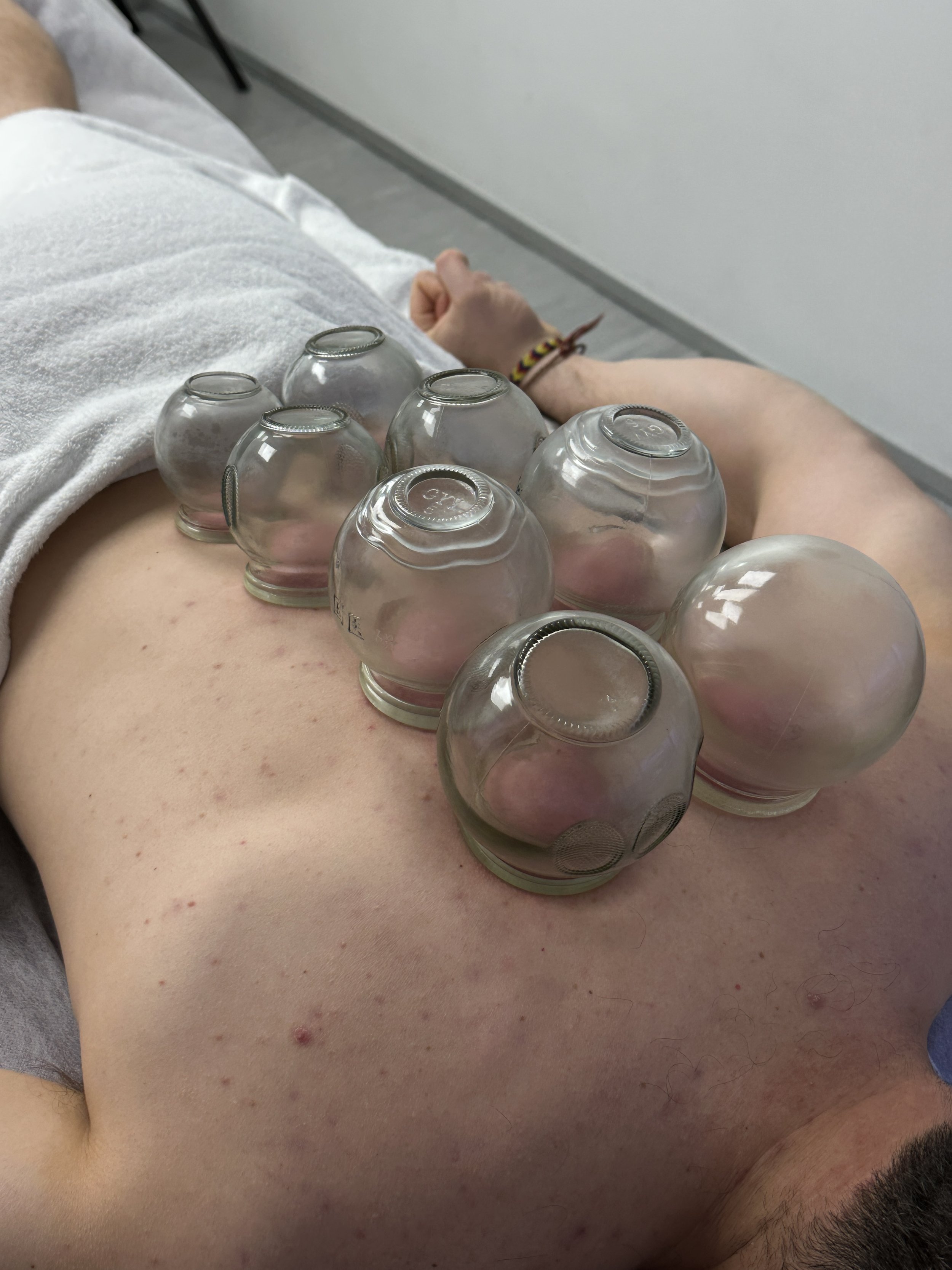 Cupping