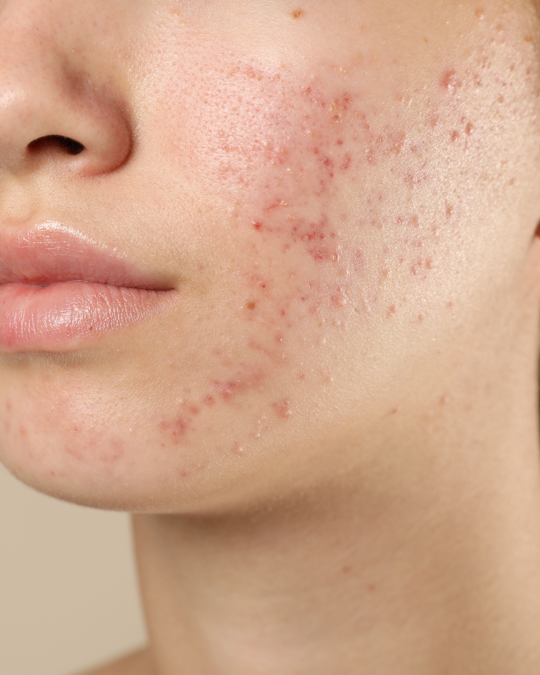 The Agniome™ Method: Our Root‑Cause Approach to Treating Adult Acne in Toronto