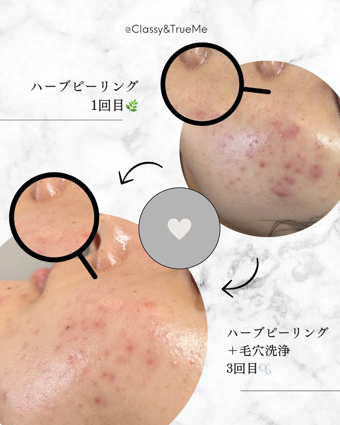 🌿 
ハーブピーリング3回目の変化！！

ここまで変わるって、
正直思ってなかったです🤭💗

ニキビ・赤み・毛穴のざらつきに悩んでいたお客様。

ハーブピーリングを継続し、
今回3回目でさらに変化✨

そして今回は
オープンイベント特典で
毛穴洗浄を無料で追加🫧

これが正直かなり大きくて、、、

拡大して見てほしいんですが
毛穴の詰まり・開きが全然違います✨️

✔ 毛穴洗浄で汚れをしっかり除去
✔ ハーブピーリングで古い角質をオフ
✔ ターンオーバーを整えて肌質改善

&ldquo;