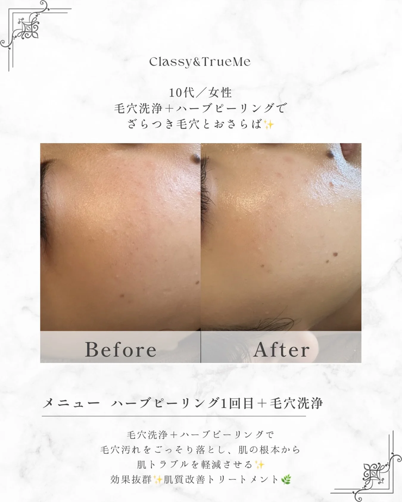 🌿 
⁡
ハーブピーリング &times; 毛穴洗浄

ざらつき毛穴、卒業しませんか？🫧

オープンイベントで
毛穴洗浄を&ldquo;無料追加&rdquo;させていただいたお客様✨

10代女性で
毛穴のざらつきや詰まりがお悩みでした🤔

そこで今回は
ハーブピーリング＋毛穴洗浄の組み合わせ🌿💧

✔ 毛穴洗浄で汚れ・皮脂をしっかりオフ
✔ ハーブピーリングで古い角質を除去
✔ ターンオーバーを整えて肌質改善

先に&rdquo;落とす&rdquo;&rarr;その後&ldquo;整