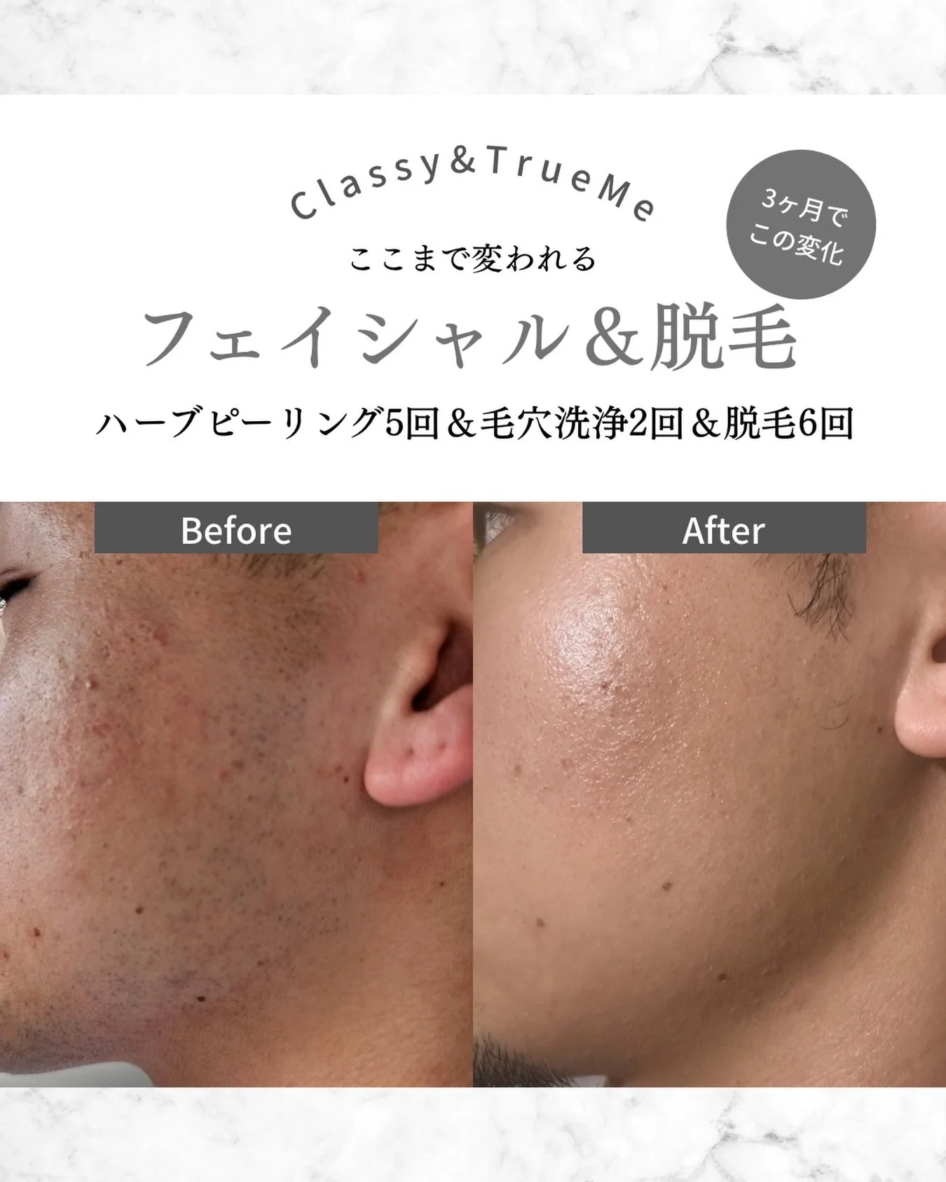 🌿 
フェイシャル＆脱毛の変化

3ヶ月でここまで変わりました😳😳

プレオープン前から
モニターとしてご協力いただいている方✨️

フェイシャルと脱毛を
定期的に継続した結果⬇️

✔ 毛穴の目立ち改善
✔ 肌荒れしにくい肌へ
✔ 全体的な肌のなめらかさUP

さらに大きな変化が、
自己処理です！！

毎日剃っていたヒゲが
&rarr; 2週間に1回、
軽く整える程度に✨️✨️

自己処理が減ることで
肌への負担も減り、
肌荒れもしにくくなります🙌

脱毛＆フェイシャルの
相乗効果の結