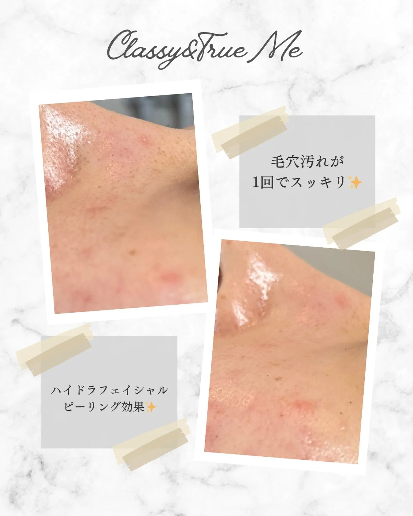 「たった1回で、このツルツル感✨️」

ずっと気になっていた小鼻のざらつきや毛穴の詰まり。

ハイドラフェイシャルのピーリング効果で、
驚くほどスッキリ綺麗に✨️✨️

自分でも思わず触りたくなるような、
なめらかなお肌に仕上がります❣️

さらに今なら！！！
🎀グランドオープン記念イベント実施中 🎀

ご予約いただいた方限定で【毛穴洗浄】を
無料で追加させていただきます！
⁡
通常価格
ハーブピーリング＋毛穴洗浄 &yen;12,000
⬇️
グランドオープン価格
ハーブピーリング＋（毛穴