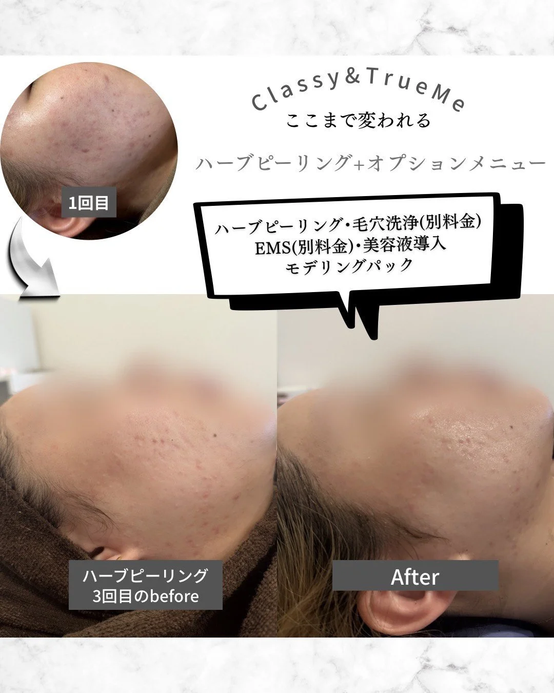 EMSによる小顔・たるみケアのビフォーアフター。電気刺激で表情筋を鍛え、フェイスラインのむくみが取れて顎ラインがシャープになった変化。