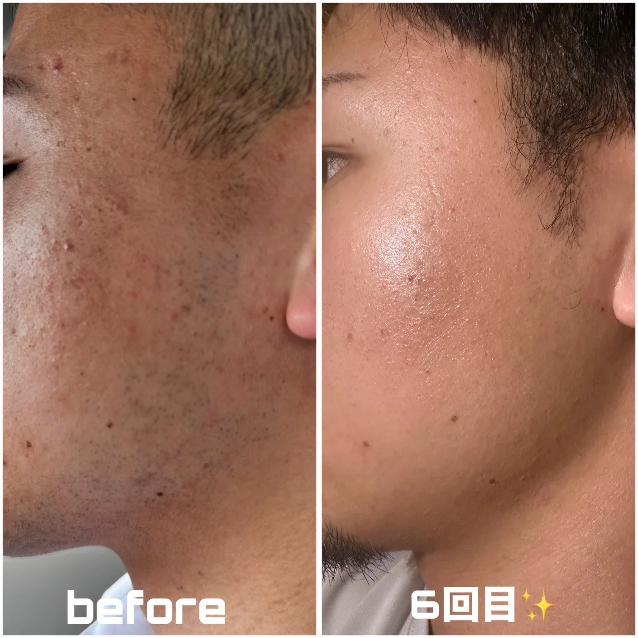 名護市印象管理専門エステClassy＆TrueMeで施術写真ハーブピーリングと毛穴洗浄（ハイドラ）と脱毛、左側は肌荒れしている顔のクローズアップ、右側は肌が滑らかで健康的に見える顔のクローズアップ。"before"と書かれている左、6回目と右に記されている。
※効果には個人差があります。