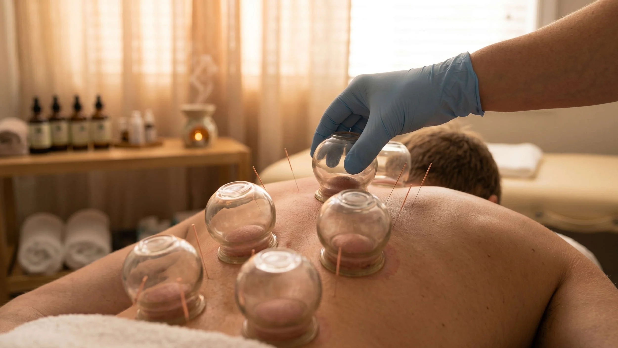 Reinhabit acupuncture Lichfield: a male patient receiving a cupping therapy treatment