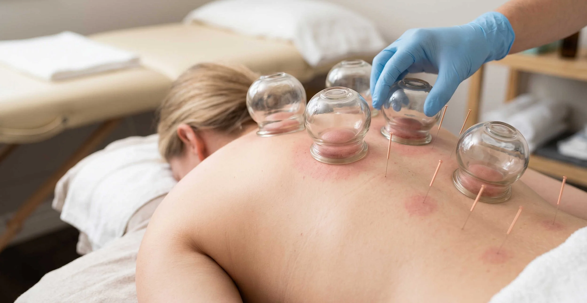 Reinhabit acupuncture Lichfield: a female patient under a cupping therapy treatment