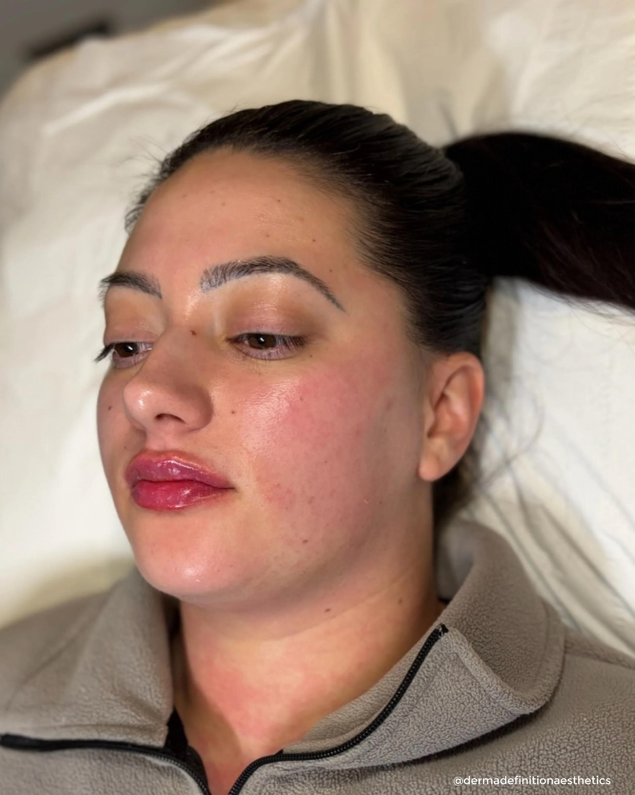 Before &amp; After | 1ml Maintenance ✨

A maintenance appointment for this lovely client to refresh volume, refine shape and keep her results looking soft and balanced 🤍

📍Kennedy&rsquo;s Clinic Locations:

Newark - @catherinecarteraestheticbeauty
