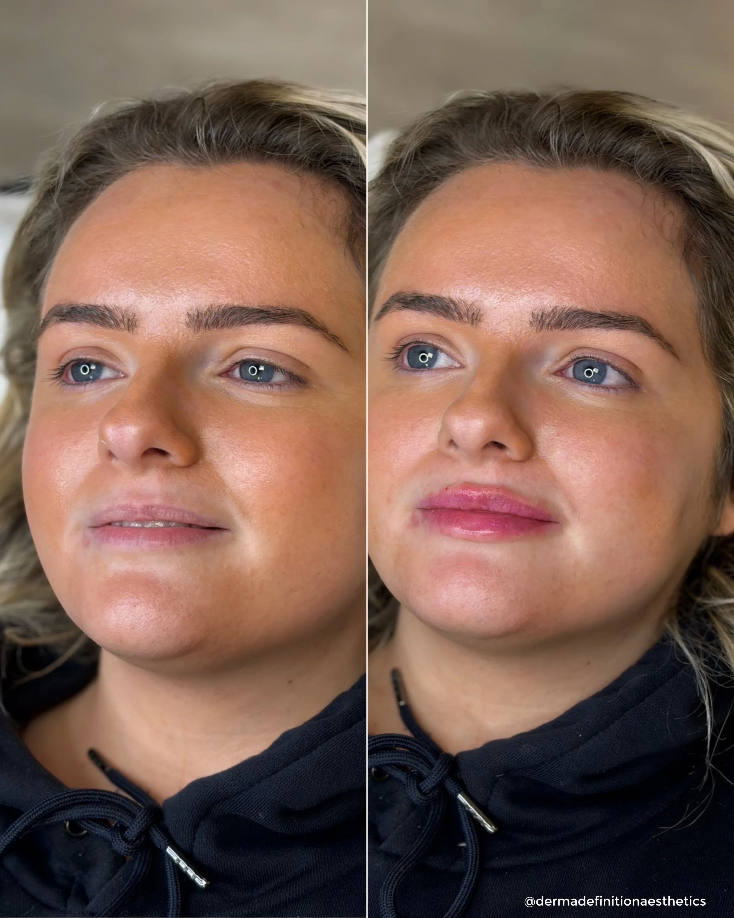 0.8ml used here to subtly enhance volume, define shape and create a beautifully balanced result👄

The goal was to keep the lips looking soft, natural and in proportion with the rest of the face, enhancing what was already there rather than completel