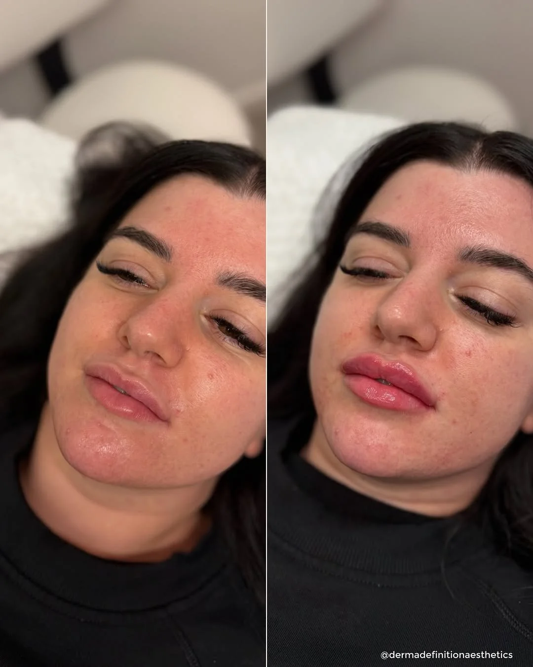 Dermal filler before and after results